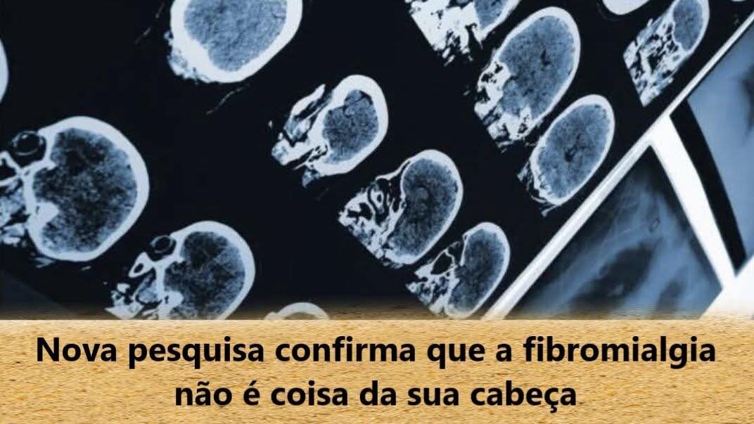 Fibromialgia