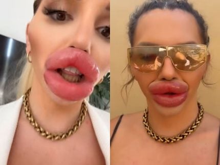 Influenciadora preenche tanto os lábios ao ponto de não conseguir fechar a boca